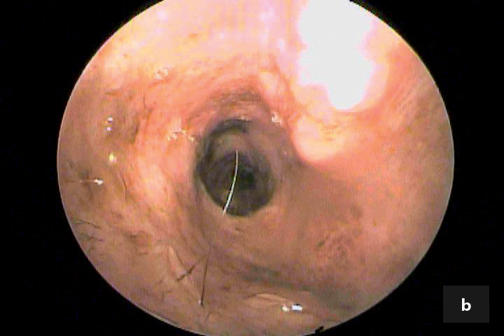 vertical and horizontal ear canals 